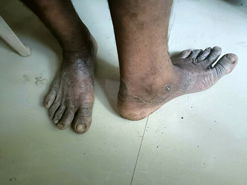 2023 06 Well Digging Case Survivor Feet 3 jpeg 202306 MUM Well Digging Rescue Approved for Full Use